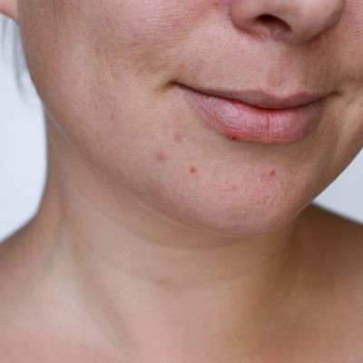 Best Acne Scar Treatment in Oman