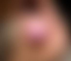 Laser Gum Depigmentation: Step-by-Step Process