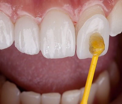 E-Max Veneers vs. Composite: Which Is Better?