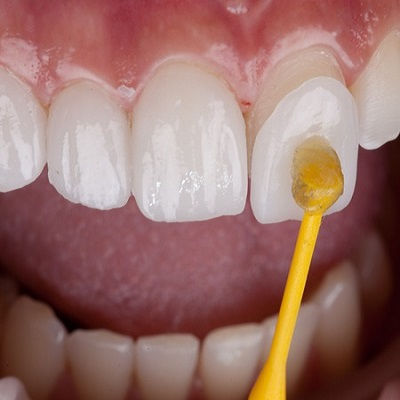 E-Max Veneers in Dubai