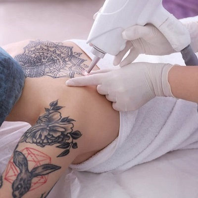 Laser Tattoo Removal Clinic in Muscat
