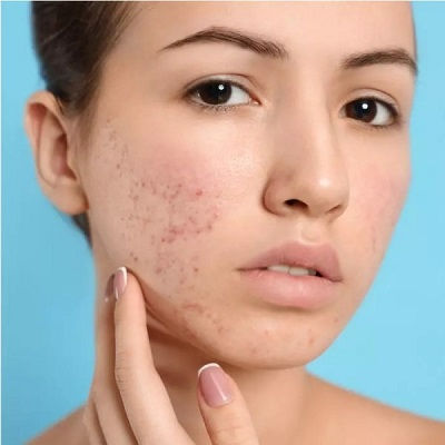 Acne Scar Treatment in Oman