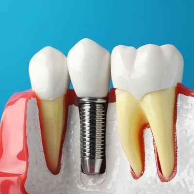 Best Dental Implants Duabi