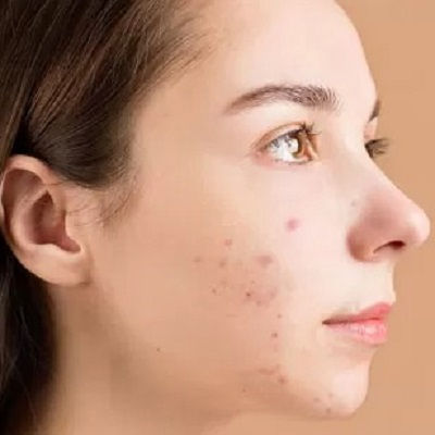 Best Acne Scar Treatment Oman