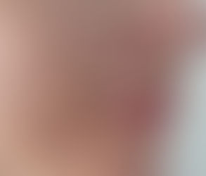 تقشير البشرة بحمض ثلاثي كلورو الأسيتيك لعلاج فرط التصبغ: كيف يعمل