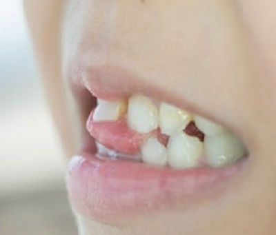 Overlapping Teeth: Exploring Alternative Treatments