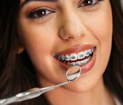 What to Expect When Getting Metal Braces
