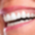Composite Veneers and Sensitive Teeth: What You Need to Know
