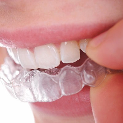 Best Teeth Retainers Dubai