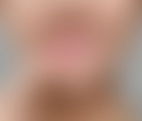 What Does Gingivectomy Feel Like With Local Anesthetic?