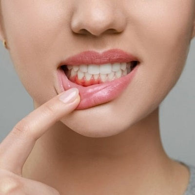Best Gingivectomy in Dubai
