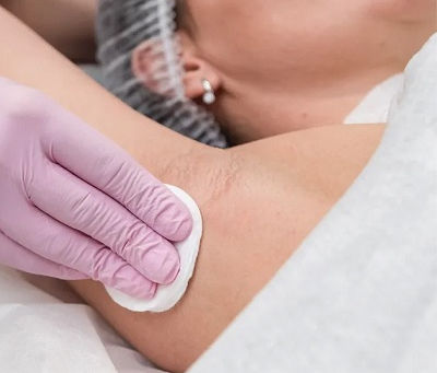 The Best Hyperhidrosis Treatments: What Works and What Doesn’t
