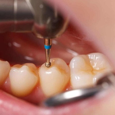 Dental Tooth Filling Dubai