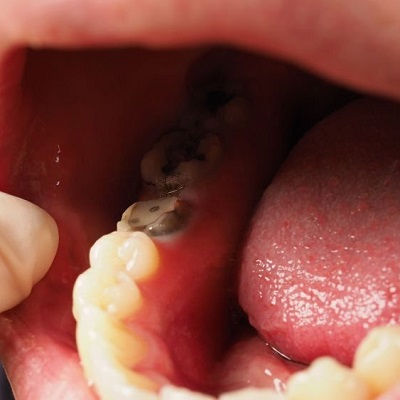 Best Root Canal Treatment in Dubai