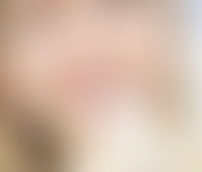 Is Tooth Sensitivity Common After E-Max Veneers?