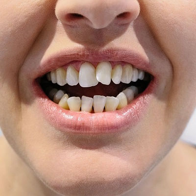 Best Crowded Teeth Treatment Dubai