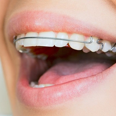 Dental Appliances in Dubai