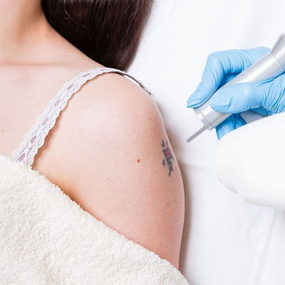 Laser Tattoo Removal Muscat