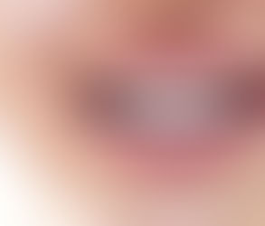 Do Dental Braces Make Teeth Yellow?