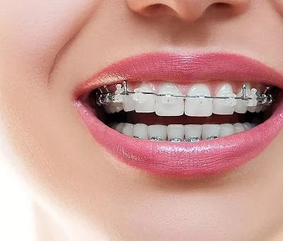 Do Dental Braces Make Teeth Yellow?