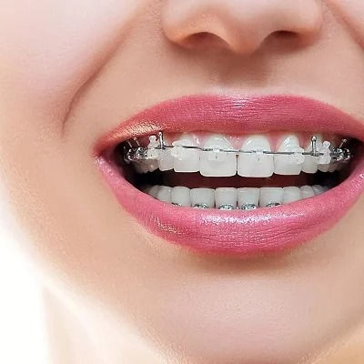 Dental Braces Dubai