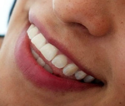Is It Normal for Adults to Grind Teeth?