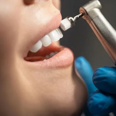 Best Teeth Polishing and Scaling in Dubai