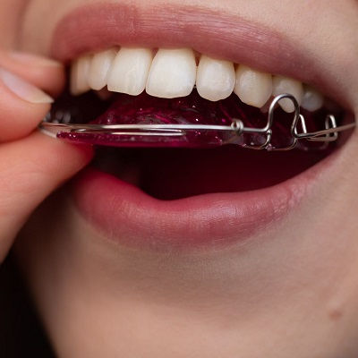 Teeth Retainers in Duabi