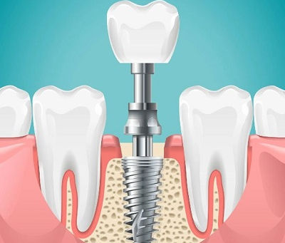 Can I Get Dental Implants with Gum Disease?