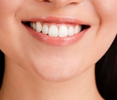 Myths About E-Max Veneers Debunked