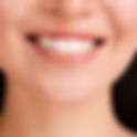Myths About E-Max Veneers Debunked