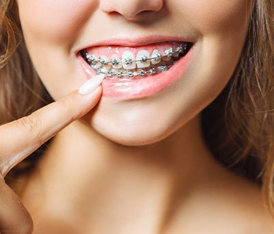 Is It Normal for Braces to Rub Your Gums?