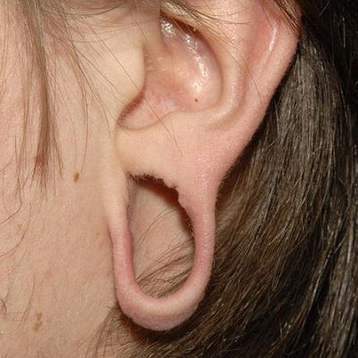 Earlobe Correction Surgery Oman