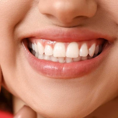 Gum Depigmentation Dubai