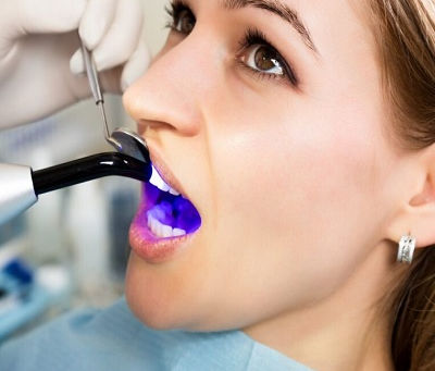 Amalgam Fillings: Pros, Cons, and Common Myths