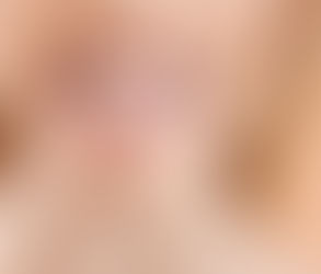 Gum Tissue Removal: What Happens If You Do Nothing?