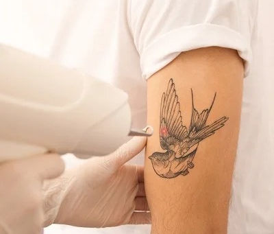 What to Expect During Your First Laser Tattoo Removal Session