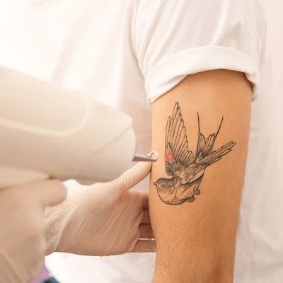 Laser Tattoo Removal in Muscat