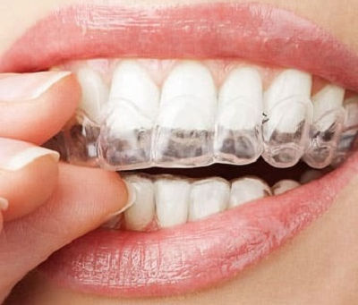 How Overlapping Teeth Can Affect Your Bite and What to Do About It