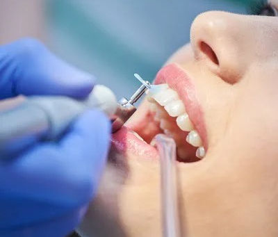 Can Teeth Polishing and Scaling Whiten Teeth?