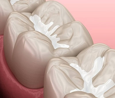 Are Dental Tooth Fillings Safe for Teenagers?