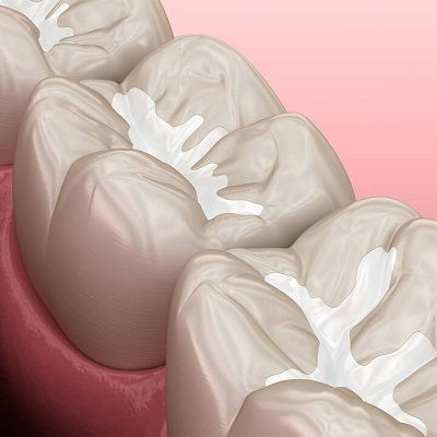 Best Dental Tooth Filling in Dubai
