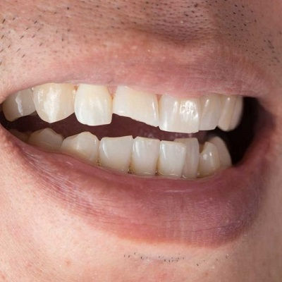 Lithium Disilicate Veneers Dubai