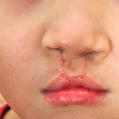 Best Palate Repair Surgery in Muscat