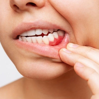 Best Gingivectomy Dubai