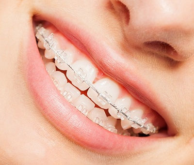 How Long Do Teeth Braces Take to Work?