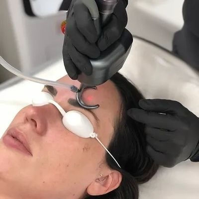 Fractional Co2 Treatment in Muscat