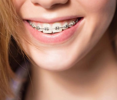 How Often Do Braces Need Tightening?