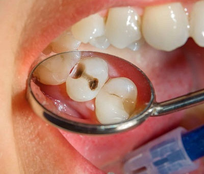 Are Metal Dental Tooth Fillings Safe for Adults?