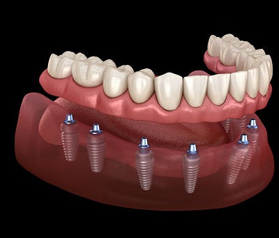 Are Dental Implants Right for You?